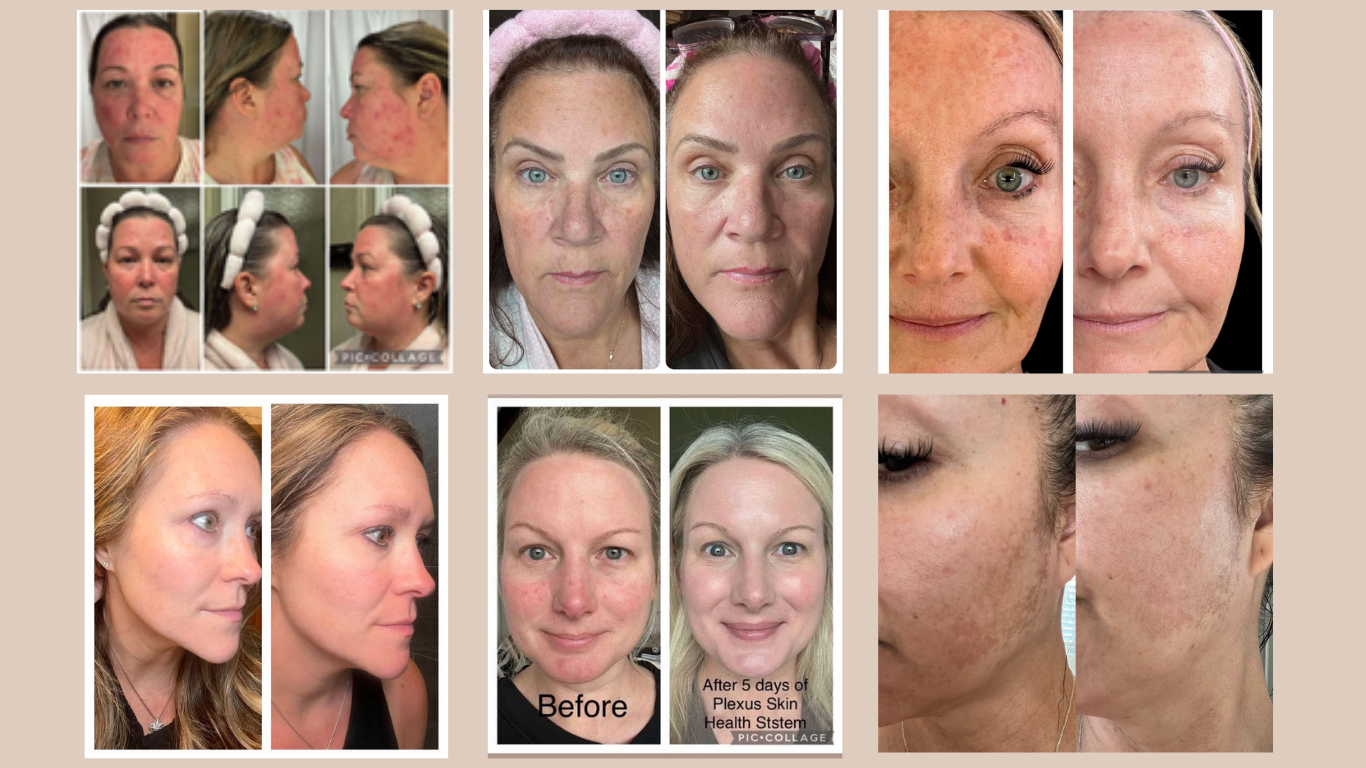 Skin health before and after transformations from women using the Plexus Skin Health System